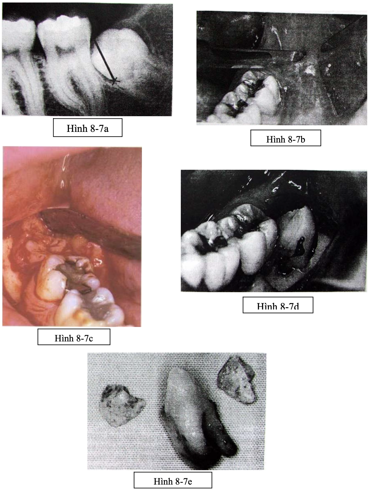 Tiểu phẫu R8 nghiêng gần